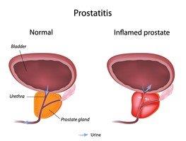 Prostatitis a stroke után